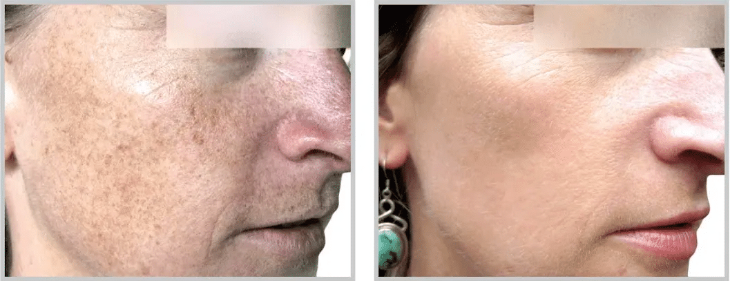 before after Laser Facial Treatment Lakeland FL