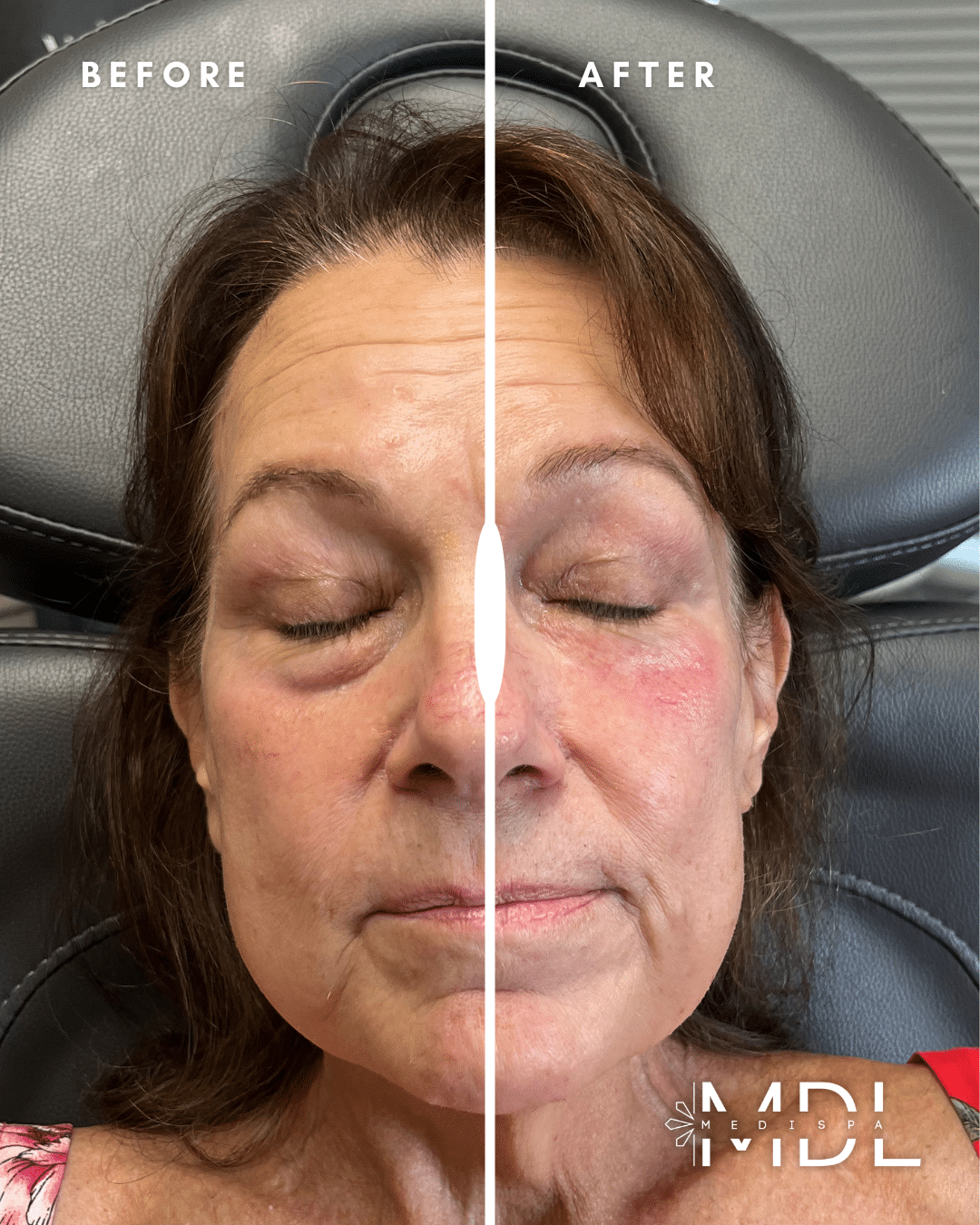 Before and After Image: Ariessence Pure PDGF+ - front