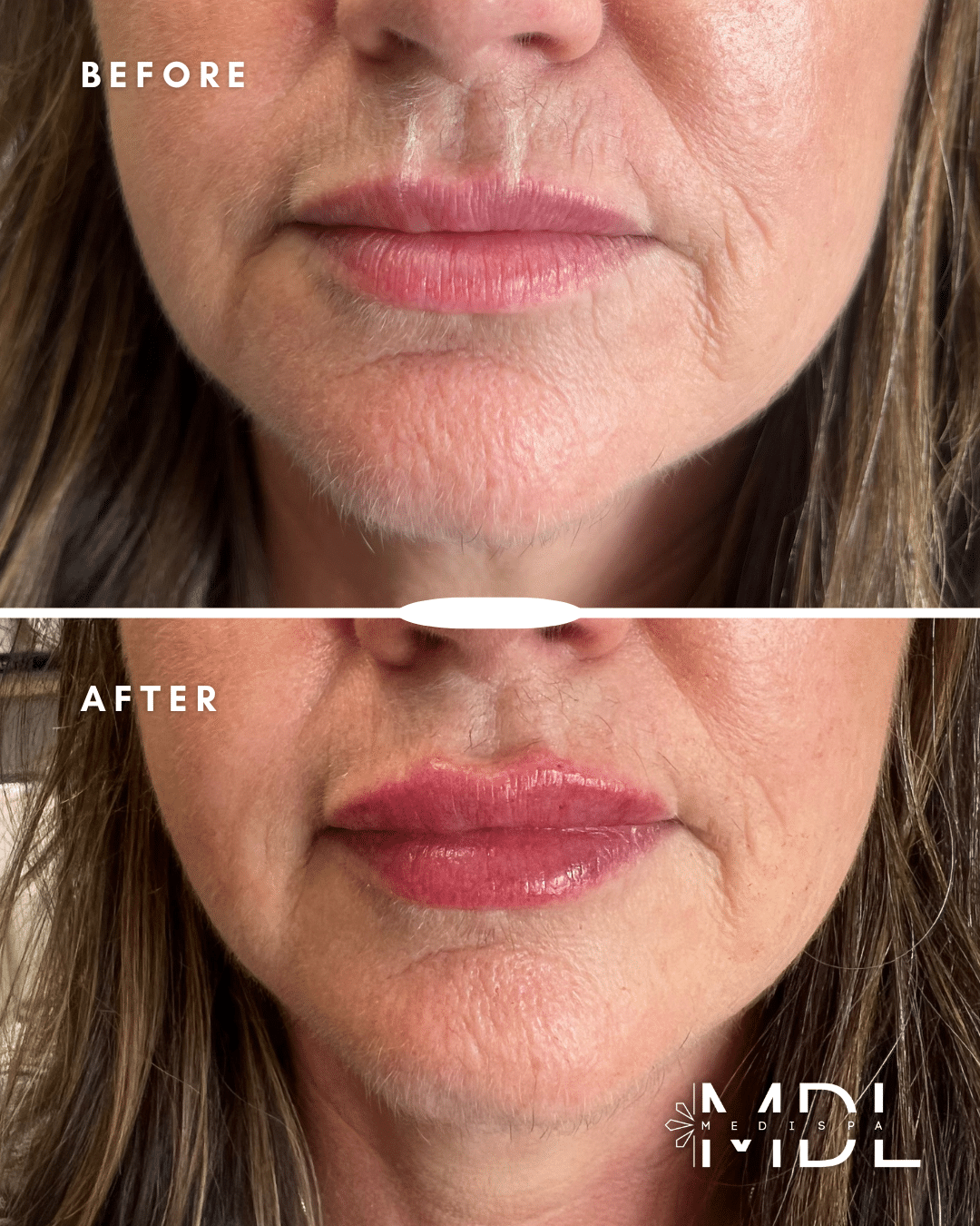 Before and After Image: Lip Filler - front
