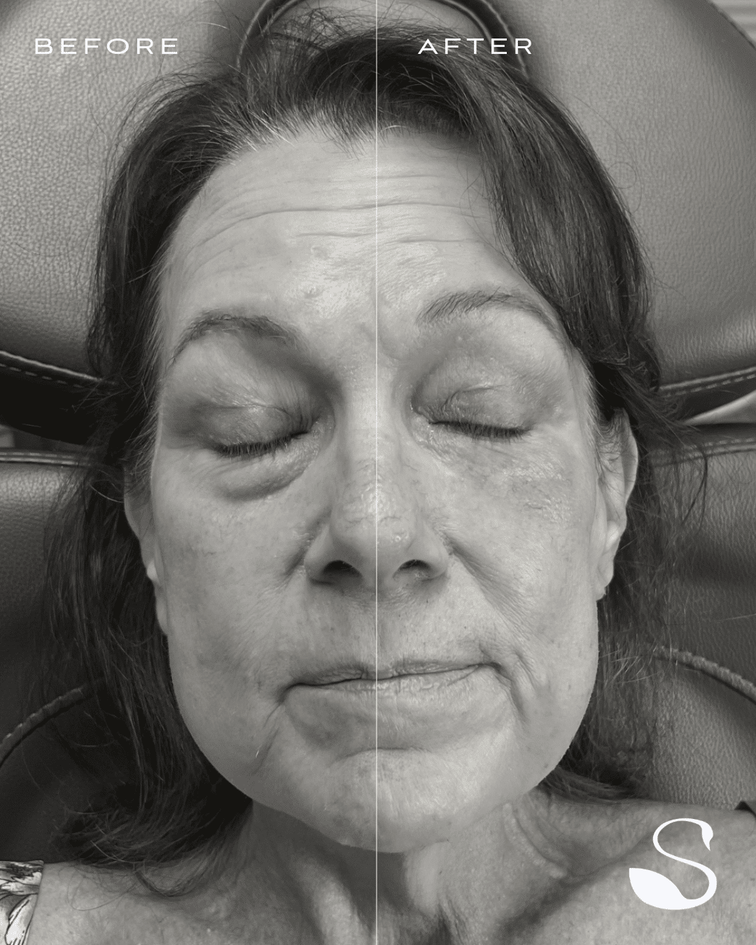 Before and After Image: Ariessence Pure PDGF+ - front