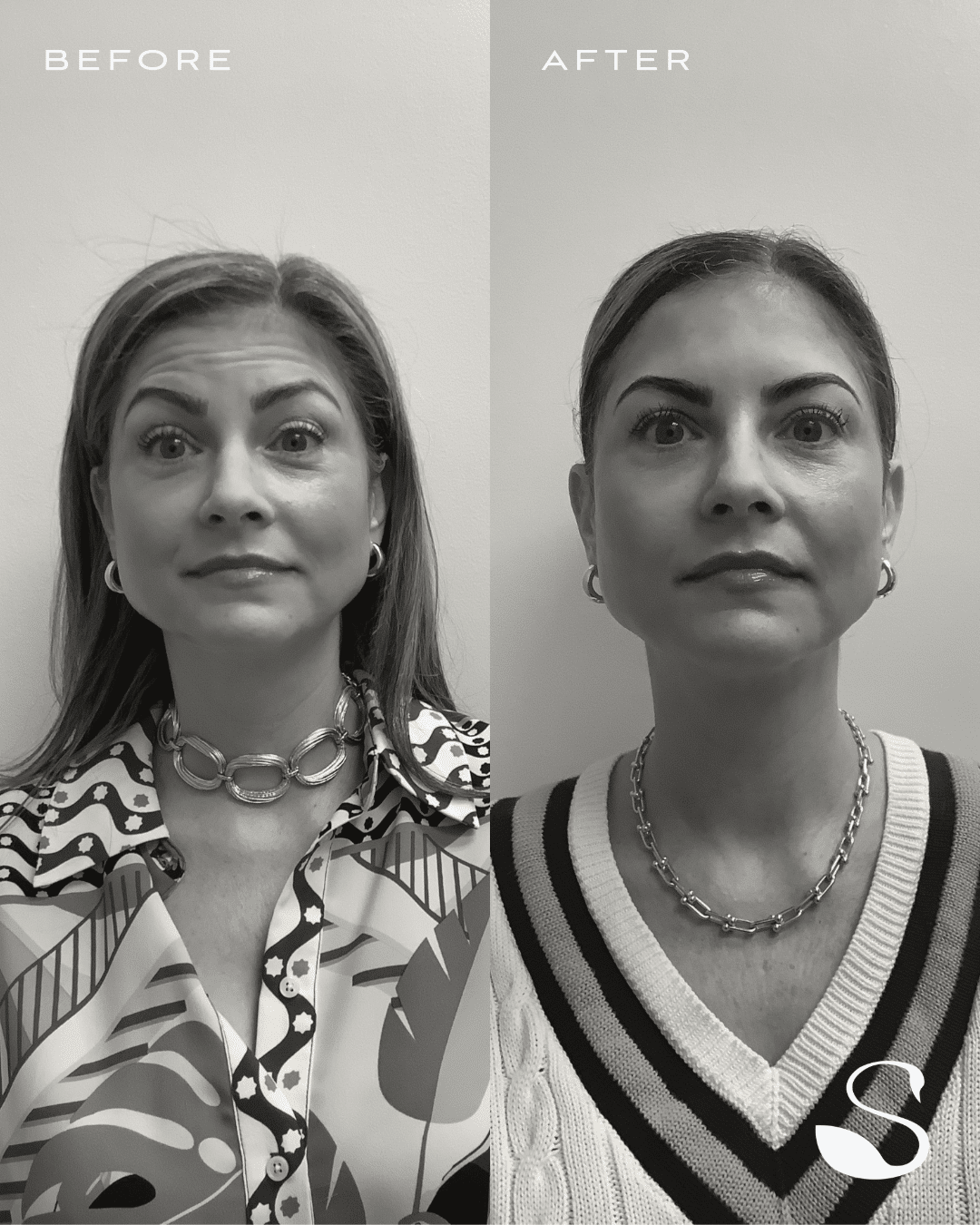 Before and After Image: Daxxify to the Frontalis and Glabella. - front