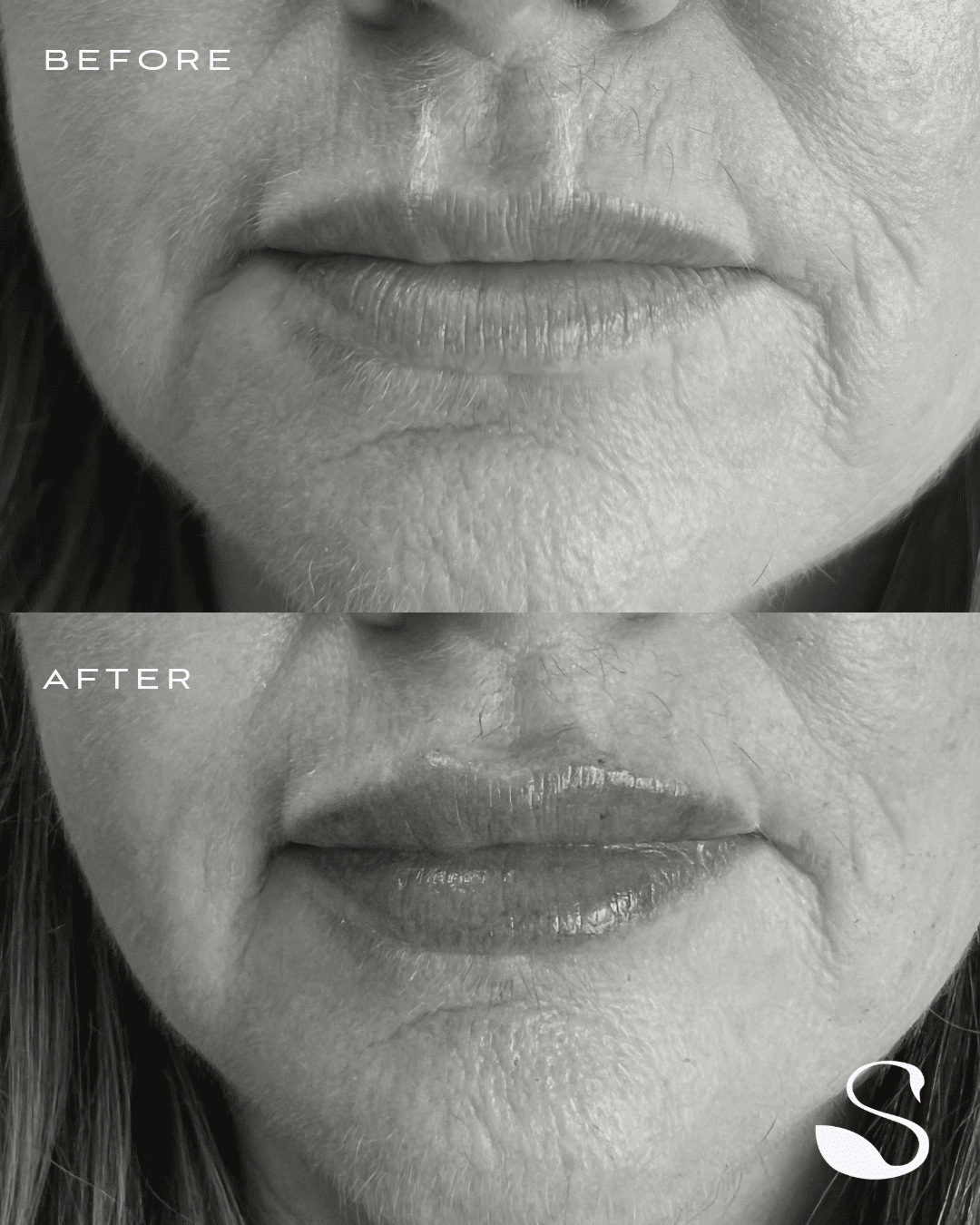 Before and After Image: Lip Filler - front