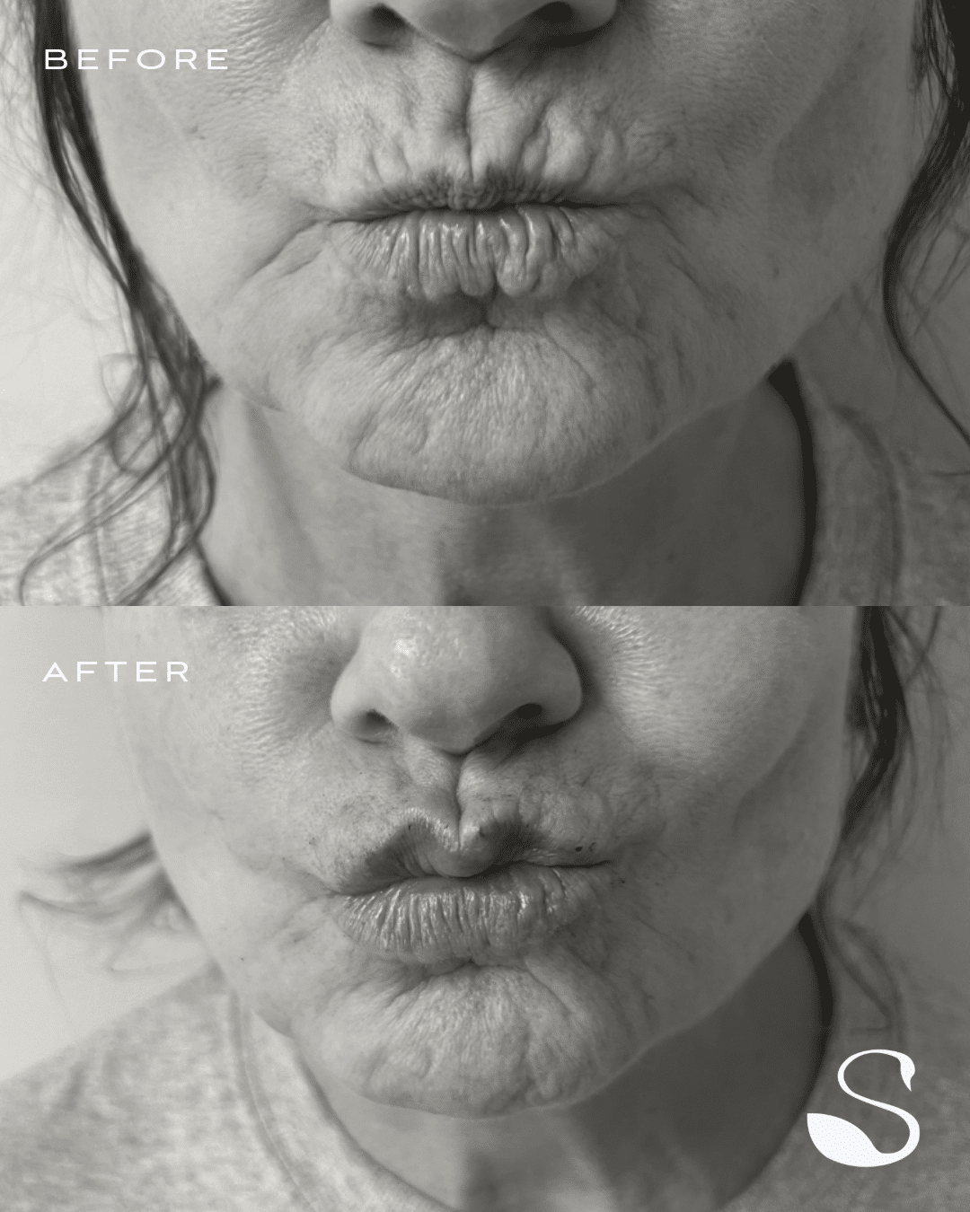 Before and After Image: Redensity – Smoker Lines - front