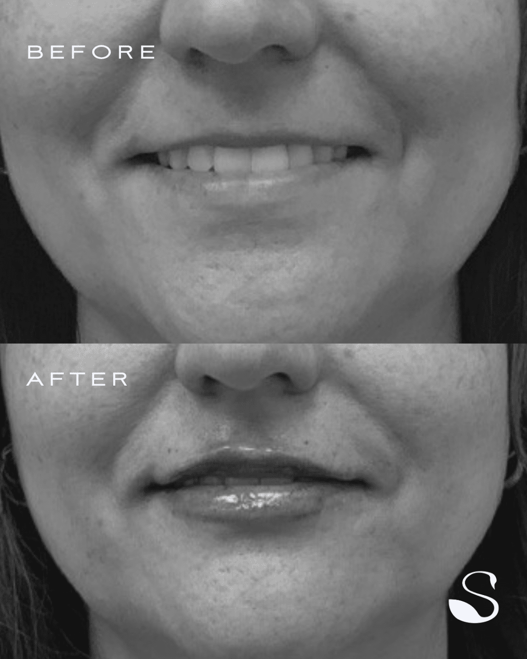 Before and After Image: Half Syringe Lip Filler - front