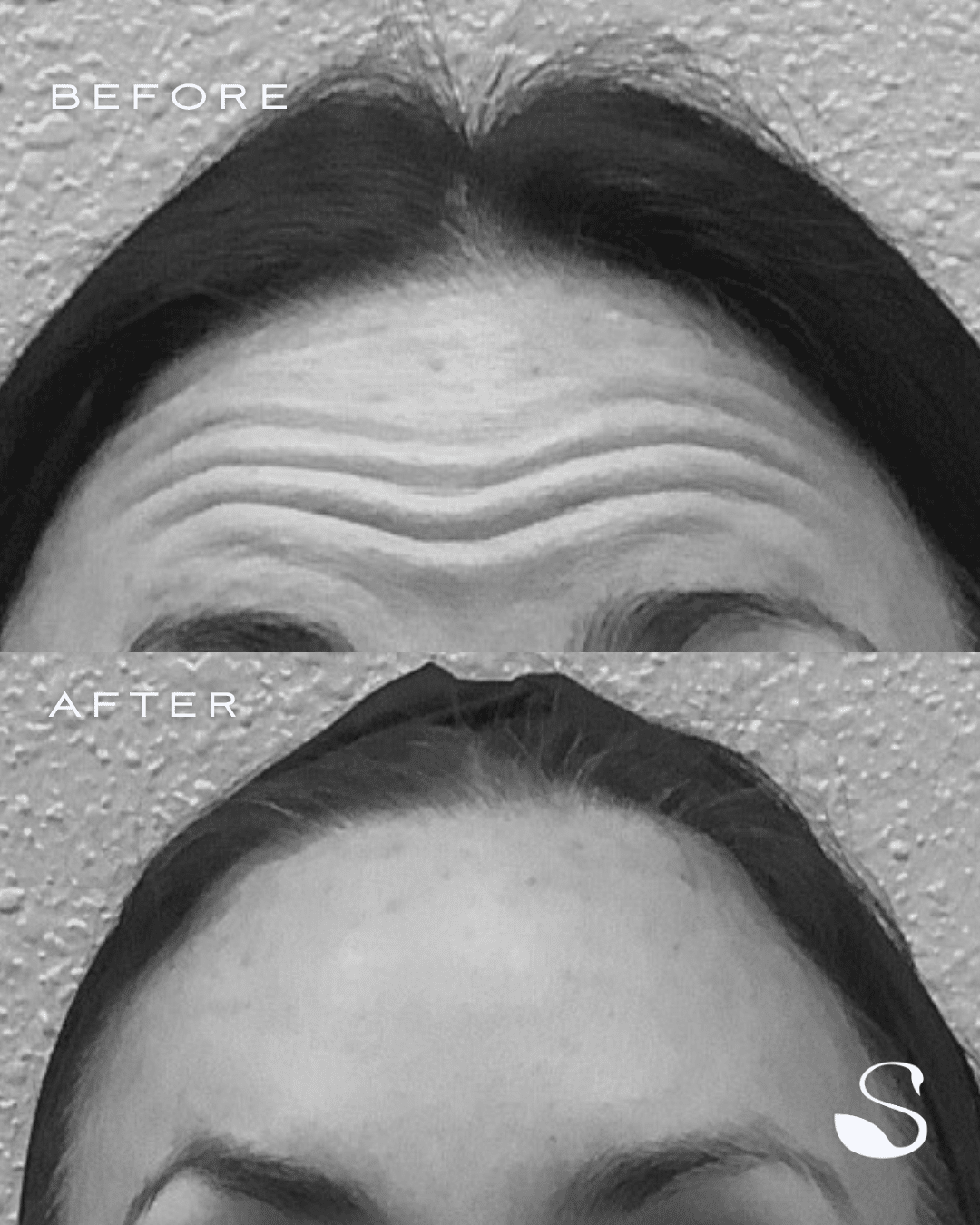 Before and After Image: Dysport to the Glabella - front