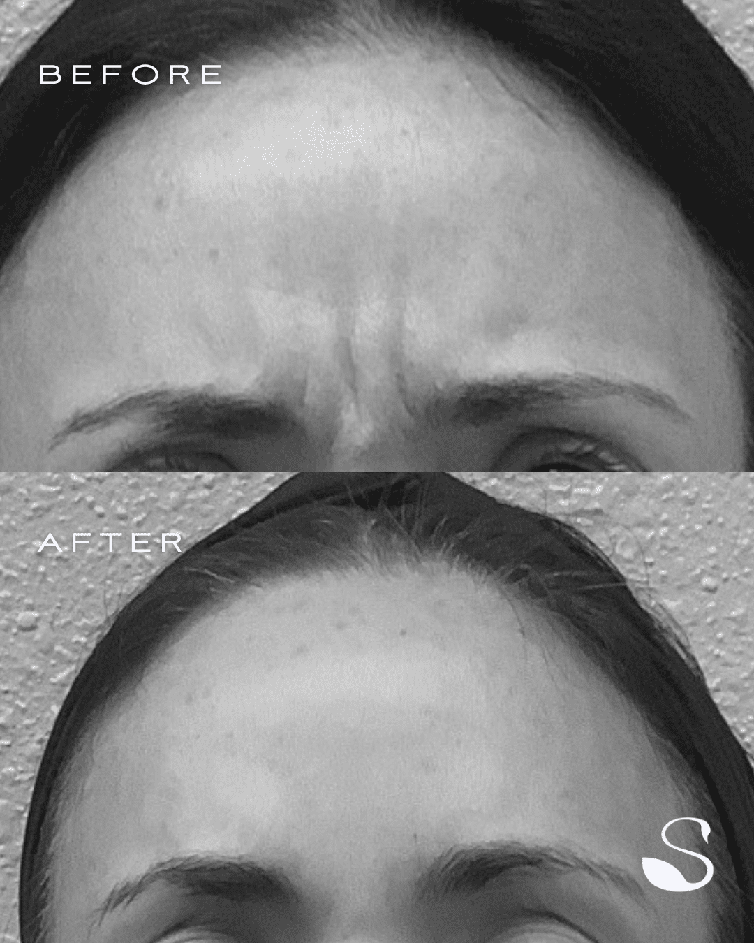 Before and After Image: Dysport to the Glabella - front