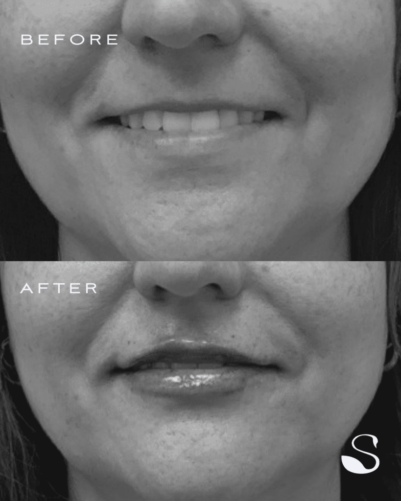 Before and After Image: Half Syringe Lip Filler - front